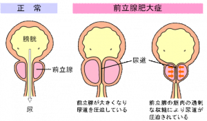 【男性必見！】前立腺肥大症を予防する食べ物5選【原因、症状、治療、予防法について】