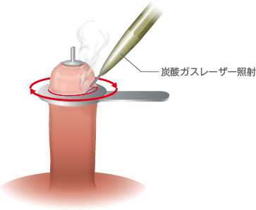 包茎の種類と手術について ｜ 烏丸御池院 いちおか泌尿器科クリニック