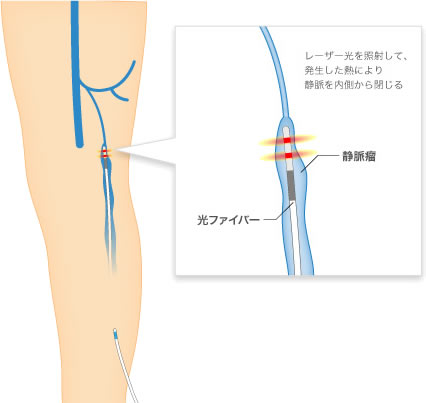 下肢静脈瘤とは？症状・原因・種類について｜名古屋の「さかえ血管外科・循環器クリニック」