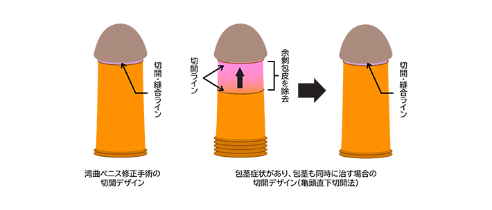 専門医師が解説】ペロニー病：勃起時の曲がりは病気だった！ 原因と治療法を徹底解説｜メンズヘルス日本版