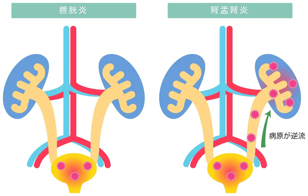 膀胱炎とセックス セックスでの膀胱炎の予防法を紹介 - TENGAヘルスケア