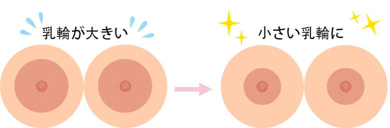 乳輪縮小のリアルな口コミ、おすすめのクリニック《美容医療の口コミ広場》