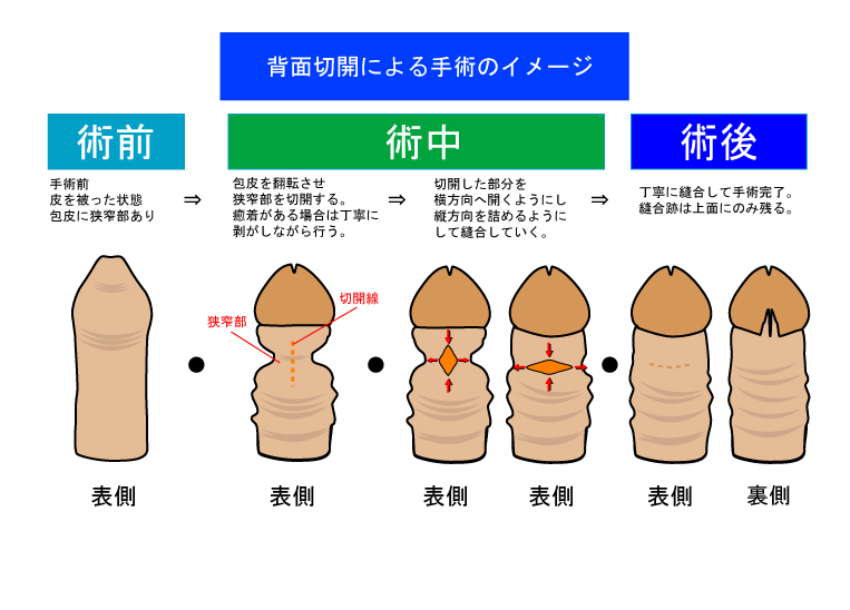 小帯切除術 – メンズ形成外科