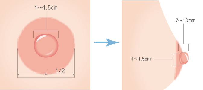 乳頭縮小・乳輪縮小｜ar2967】の症例写真 | 東京美容外科