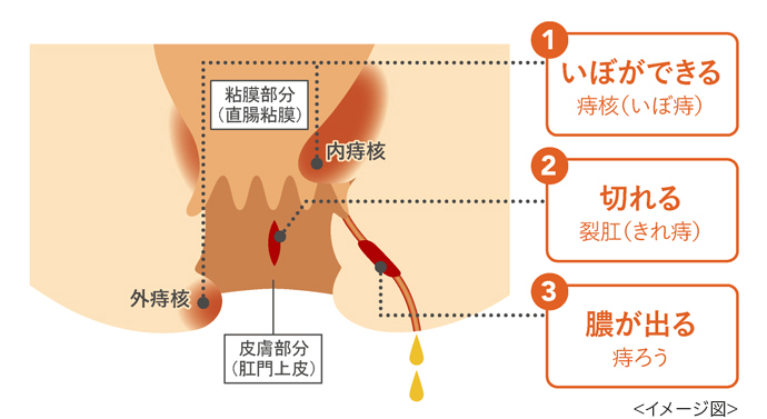 赤ちゃんの痔の治し方】切れ痔・痔ろうのケア。病院は何科？ | kosodate