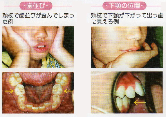 歯科矯正で横顔はきれいになる？症例別の変化と変わらない人の特徴を解説