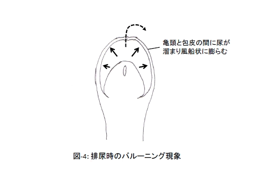 包茎を自然に治す方法はあるのでしょうか？？ – メンズ形成外科 | 青山セレス&船橋中央クリニック