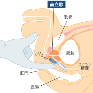 前立腺炎（慢性前立腺炎） | 慢性痛治療の専門医による痛みと身体のQ＆A