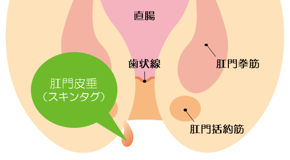 切らない包茎治療 東郷式・ハビット法について」症例写真更新中- |