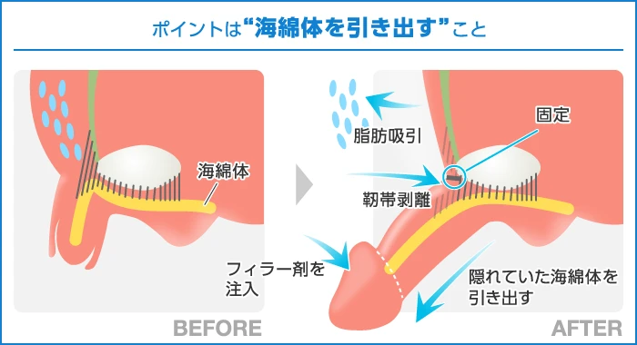 インプラント と セラミック（かぶせ物）