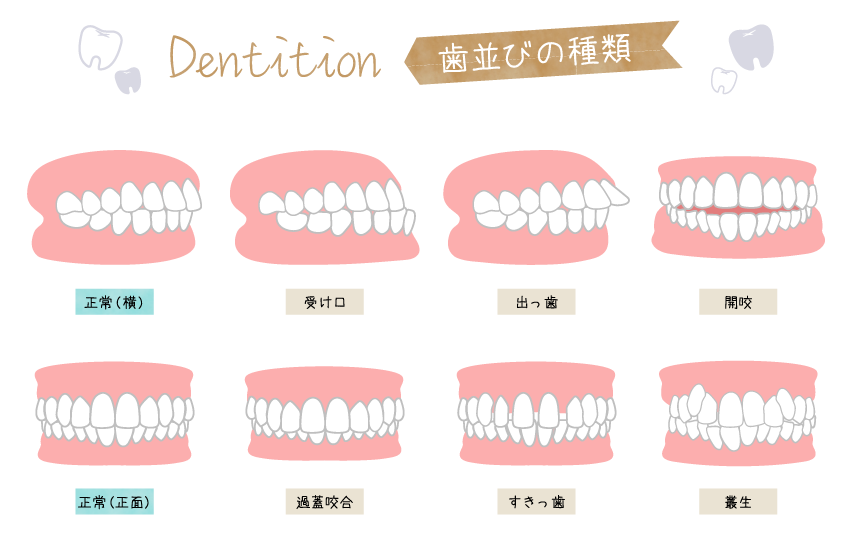 顎が小さい（歯槽骨形態修正） | 石井歯科矯正歯科医院