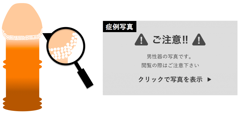 シリコンボール・ペニスリング ： 男性器（包茎、長茎など）：美容外科