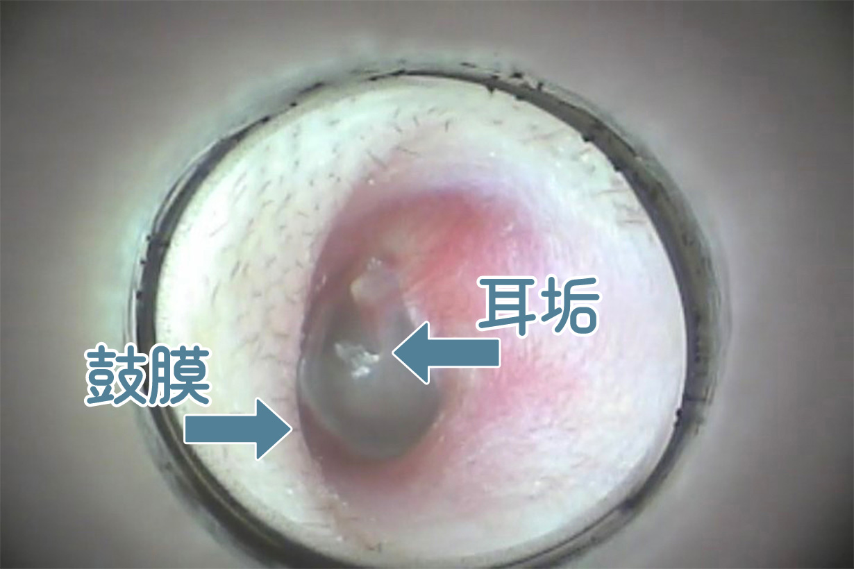 耳がかゆいと何故耳かきしてしまうのか？ -痛みとかゆみ – | 定永耳鼻咽喉科