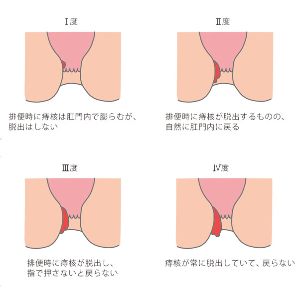 薬剤師が解説】お尻の穴が痛いときにおすすめの市販薬はどれ？9選を紹介 – EPARKくすりの窓口コラム｜ヘルスケア情報