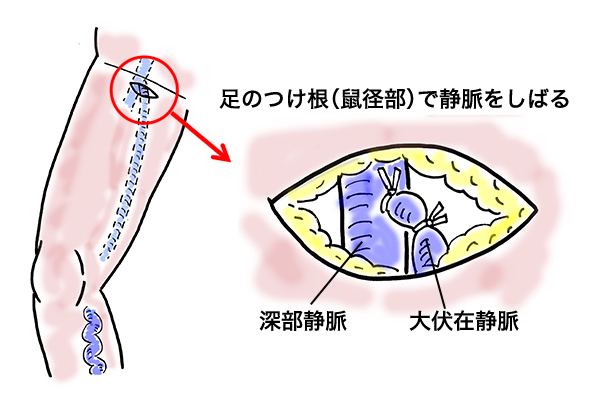 腹直筋離開と鼠径部の痛みは関係ある？ | 柏市のおすすめNo.1やぎはし整体院【芸能人が通う柏の『本当に治る』と評判の整体院】