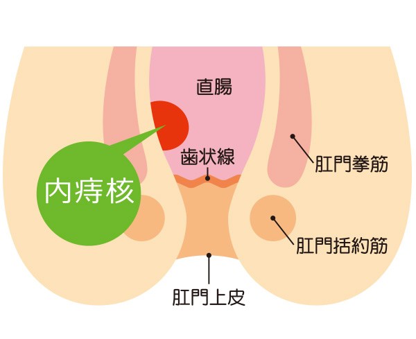 肛門尖圭コンジローマ・血栓性外痔核・直腸脱で肛門科なら品川区・目黒区痔の日帰り手術NAVI