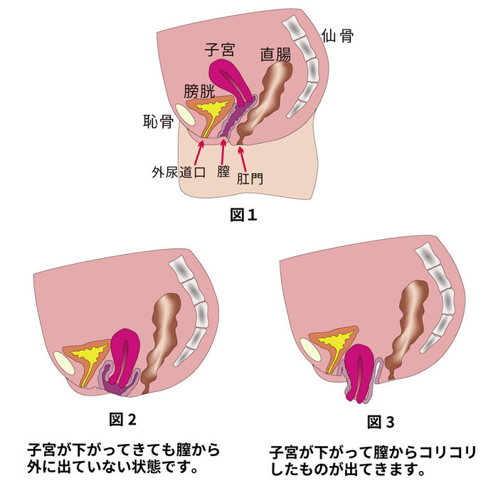 女性の骨盤臓器脱治療はどうする?」 - きょうの健康 - NHK