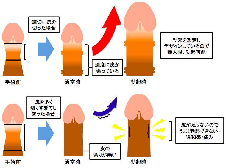 包茎「おちんちんの皮についてのお話し」｜にじいろ子どもクリニック｜小児科