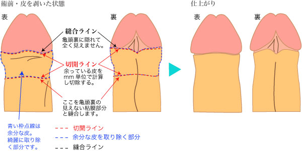 傷跡修正・異物除去 | 鹿児島・福岡・東京 男性治療専門外来