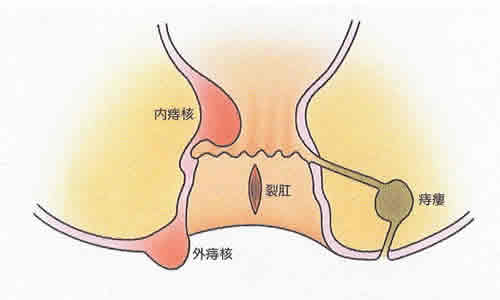 下痢でおしりの穴が痛い時の対処法には何がありますか？ ｜おしりの穴が痛い