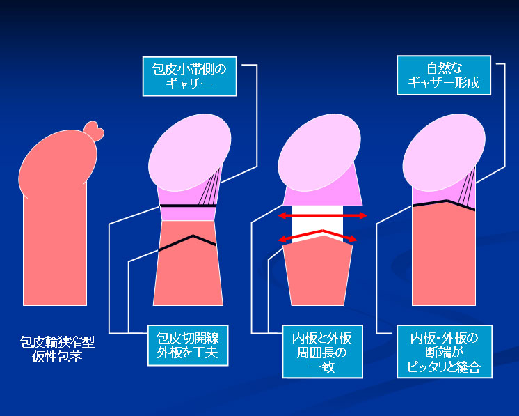 本田ヒルズタワークリニック包茎ガイド | 本田ヒルズタワークリニック公式
