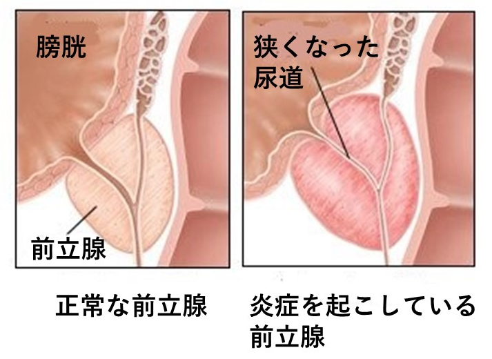 前立腺がん｜神戸市東灘区 摂津本山｜いしむら腎泌尿器科クリニック