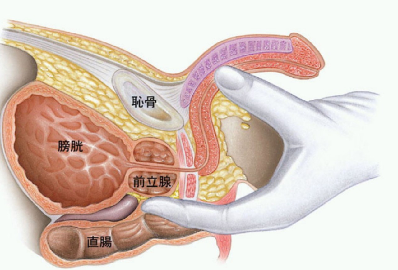 対象となる病気 前立腺がん｜診療紹介｜金沢医科大学 泌尿器科学