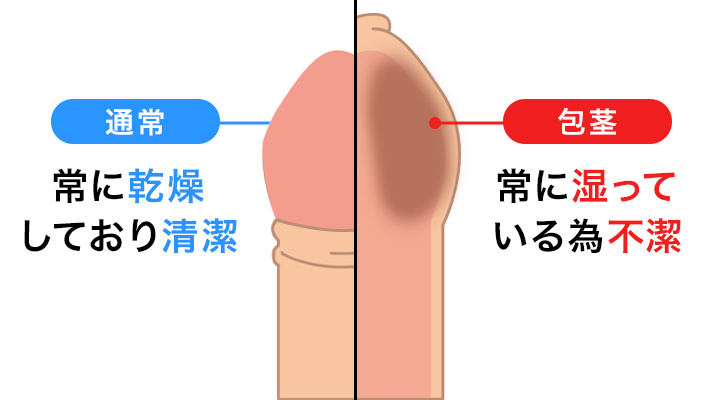 真性包茎を治した方が良い理由9つと3種類の治し方 | STERON