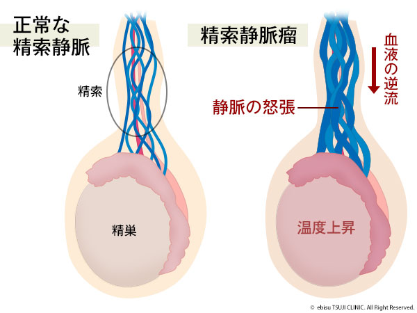 血精液症｜神戸市東灘区の「いしむら腎泌尿器科クリニック」