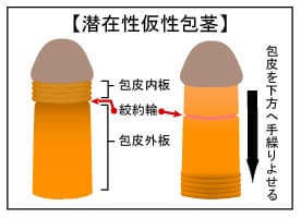 包茎手術体験談 ～世界一の遅漏が語る、20年越しの後悔～ - TENGAヘルスケア