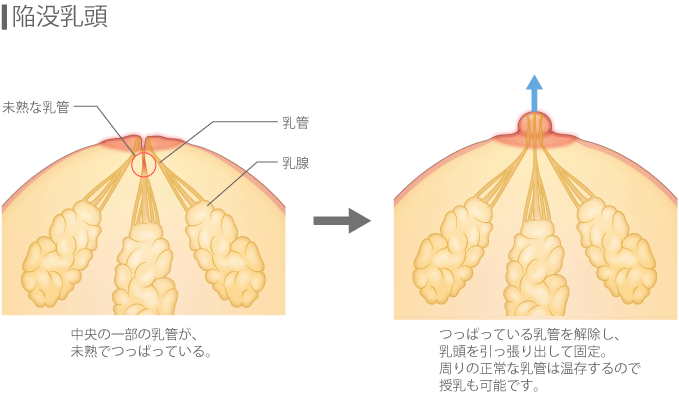 専門医が解説】男性の乳頭縮小術に関して知っておくべき３つの知識