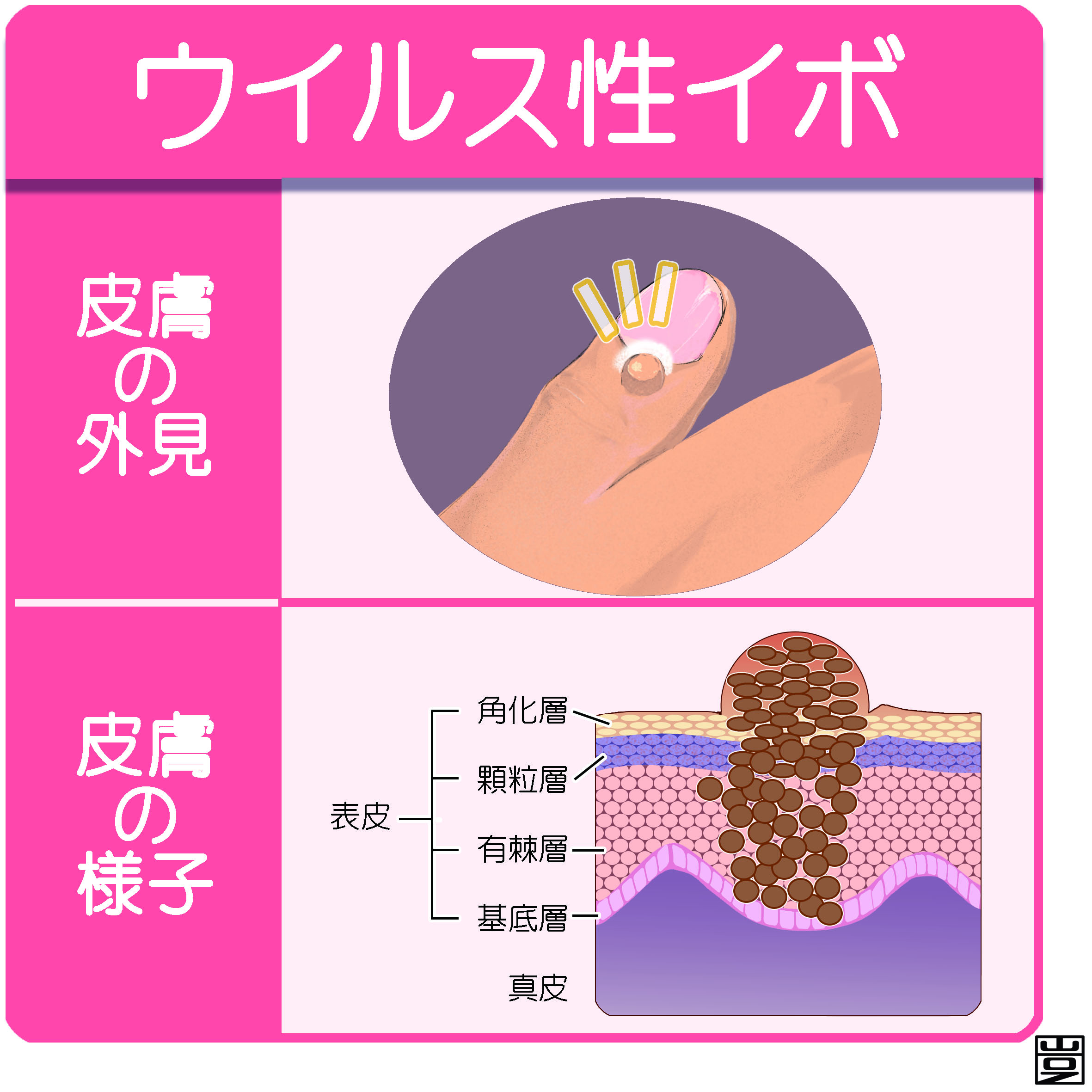 ウイルス性イボ(尋常性疣贅)とは(治療など) | 新宿駅前クリニック皮膚科