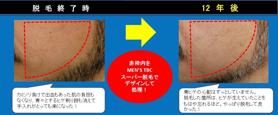 MEN'S TBCでヒゲの針脱毛体験を受けてきた※本音のレビュー＆写真付