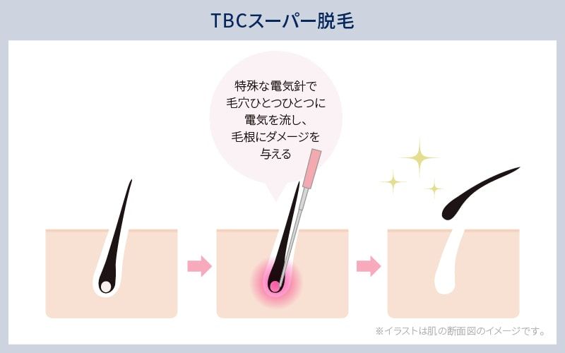 公式】TBCスーパー脱毛｜通い方・コースの流れ｜脱毛ならエステティックTBC