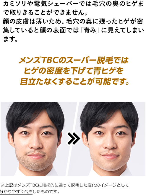 メンズTBCのヒゲ脱毛｜料金は高い?体験の口コミは悪い?脱毛効果や痛みも解説